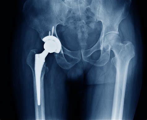 Having a Hip Replacement in Mexico: What You Need to Know