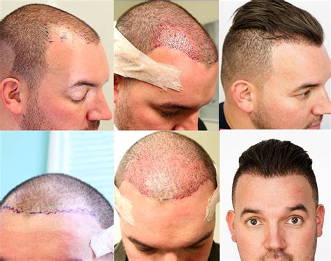 Hair Transplant Holidays: 3 Top Destinations for High-Quality Care
