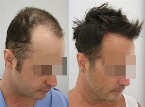 Hair Transplants in Turkey: An Insider's View of the Process